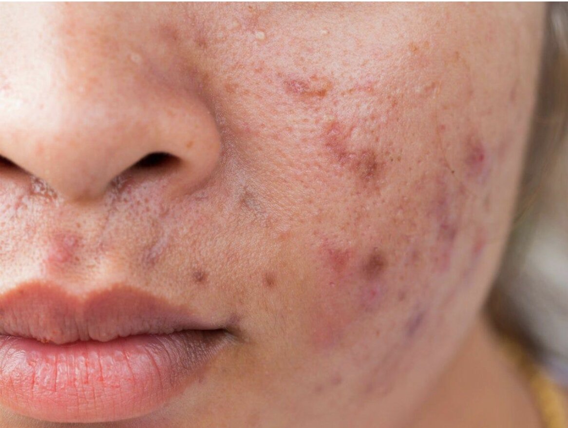 The Maskne Epidemic What's Really Causing the Acne Around Your ...