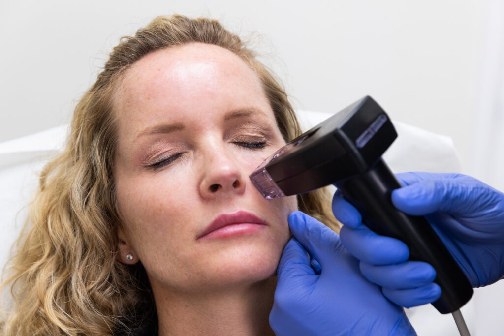 Close-up of a female patient receiving microneedling treatment after learning about Morpheus8 benefits