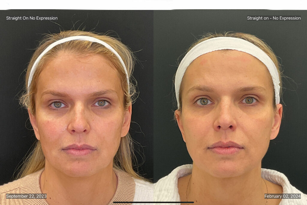 A female patient's before and after photos showing Morpheus8 results